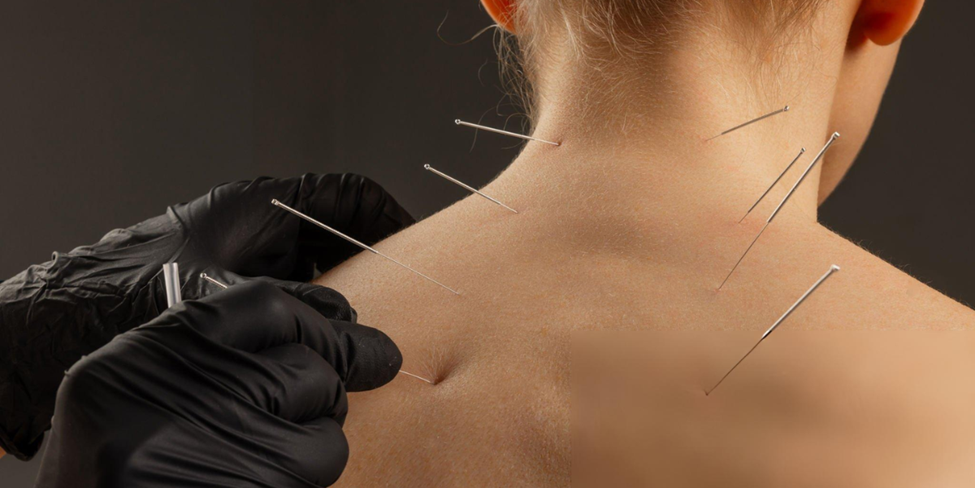 Acupuncture for Chronic Pain